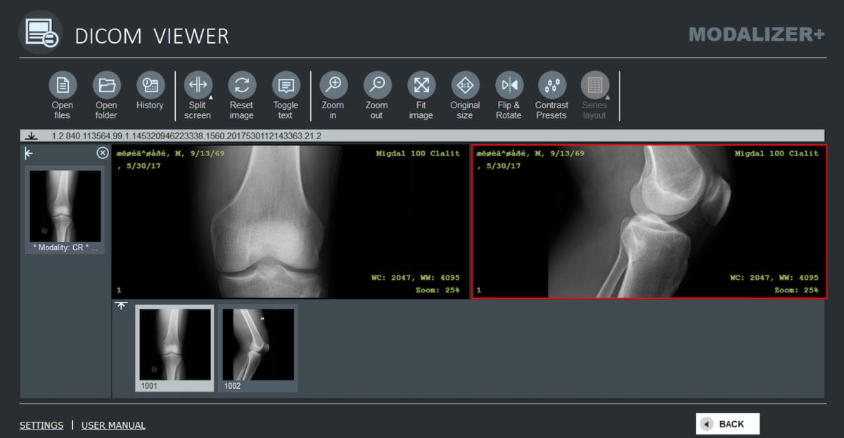 X-ray images of a knee as displayed by MODALIZER+ Free DICOM Viewer