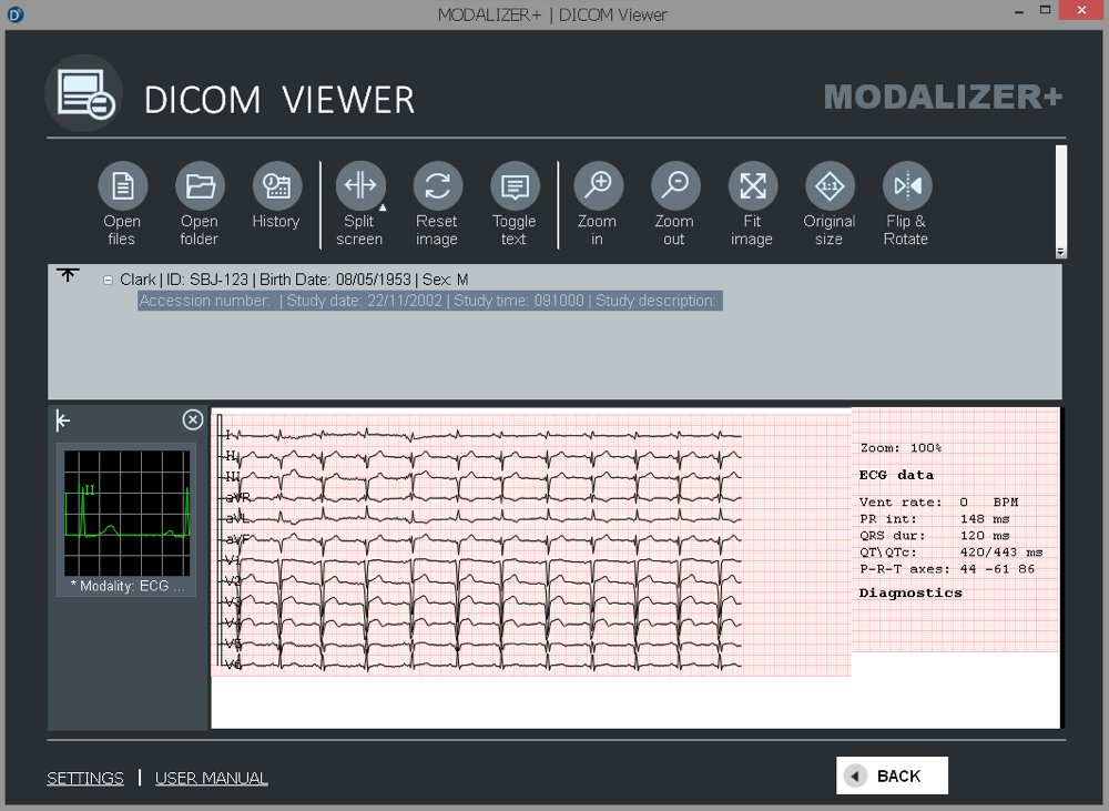 MODALIZER+ 12-lead ECG DICOM viewer showing waveform traces and diagnostic measurements